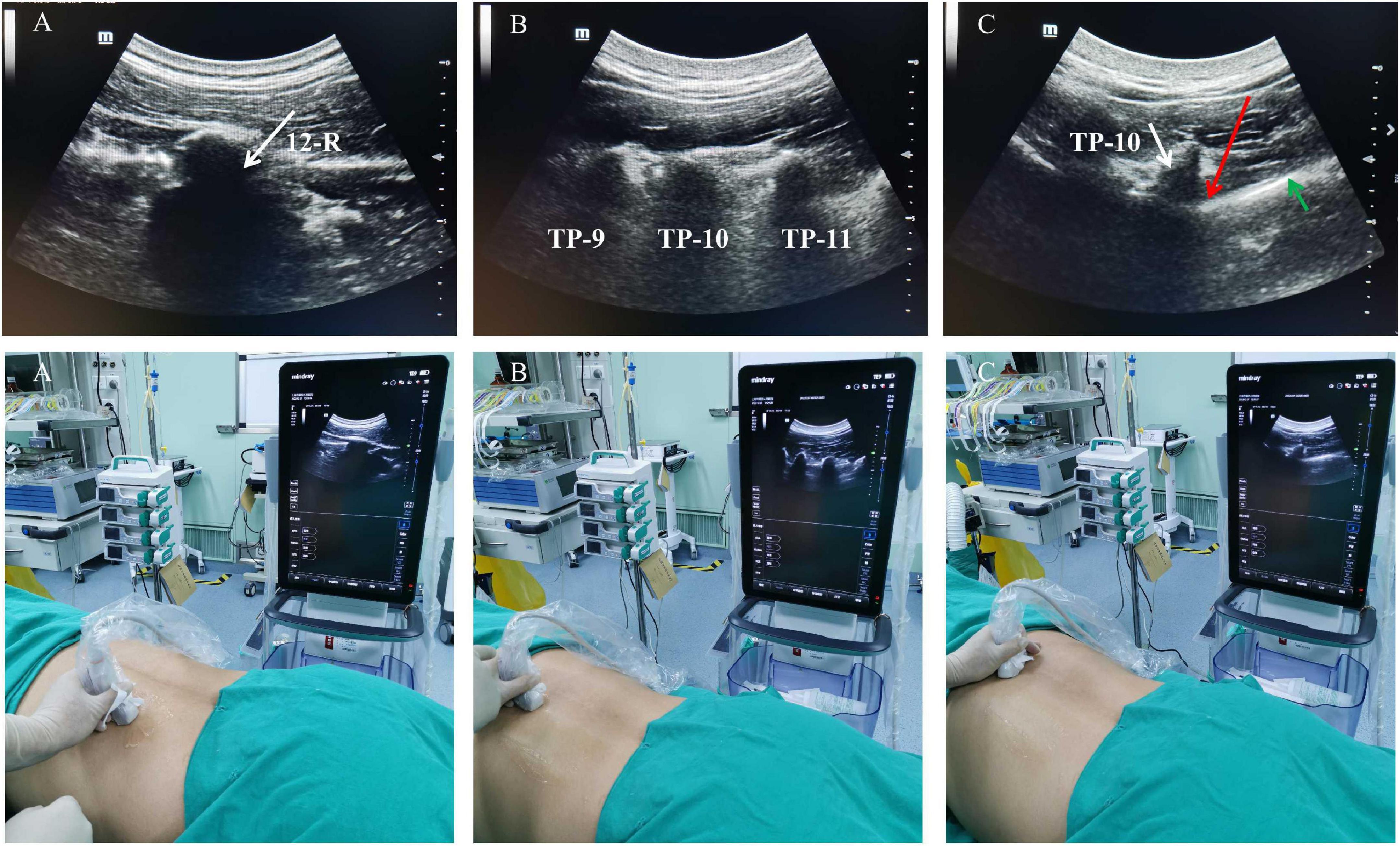 Comparison of paravertebral block vs. general anesthesia for percutaneous nephrolithotomy: A retrospective study